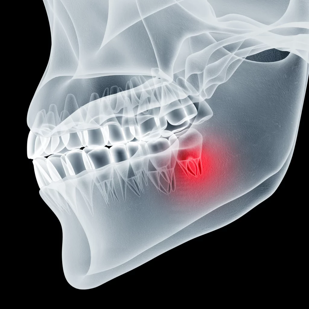 wisdom teeth removal in Manhattan Beach, CA