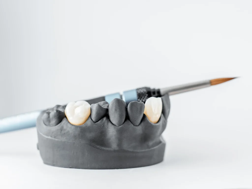 jaw model showing different types of dental crowns