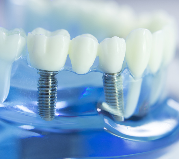 Manhattan Beach Dental Implants
